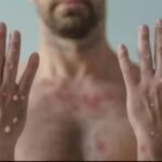 Paciente com varíola dos macacos morre em Crateús TEMA LIVRE